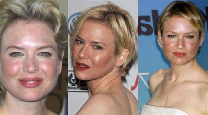Celebrities with Rosacea Famous People With Rosacea